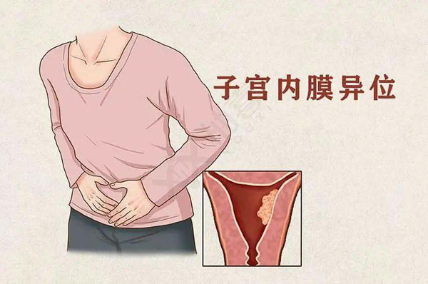 子宫内膜异位症与怀孕的关系